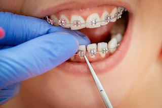 Chi phí niềng răng mắc cài inox -3