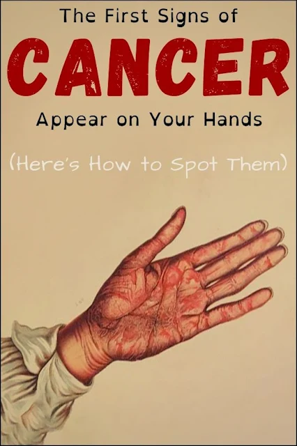 Cancer Symptoms Appear First On Your Hands, Don’t Ignore Them!