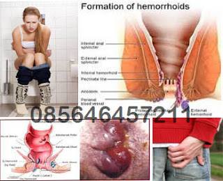 Tanda2 Terkena Penyakit Wasir Luar dan Dalam