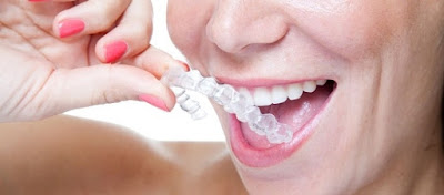 Niềng răng không mắc cài có ưu điểm gì? 