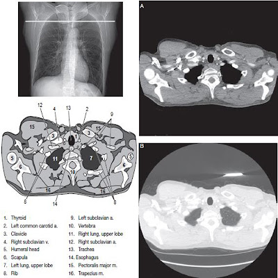 chest CT