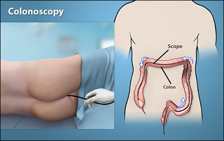 Colonoscopy