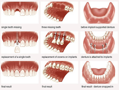 Phương pháp trồng răng giả có đau không?
