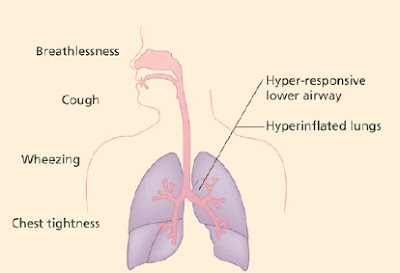 What are the Symptoms of Asthma