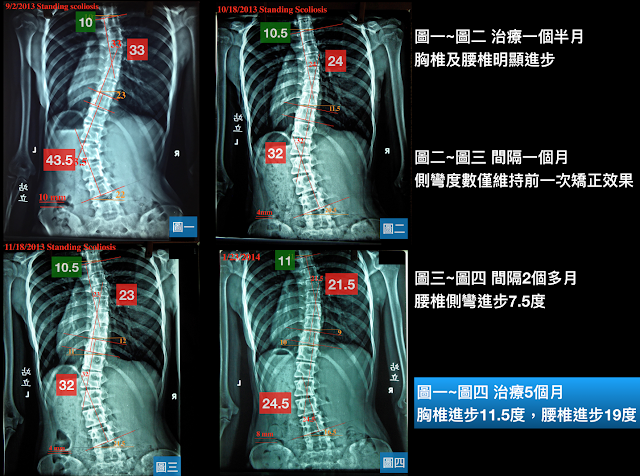 脊椎側彎, 脊椎度數, 脊椎側彎矯正, 脊椎側彎治療, 脊椎側彎矯正成功案例, 脊椎側彎 推薦, 脊椎側彎 台中