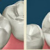 Trám răng Composite có duy trì lâu không?