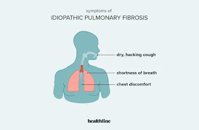 Idiopathic pneumonic fibrosis ( Formola)...