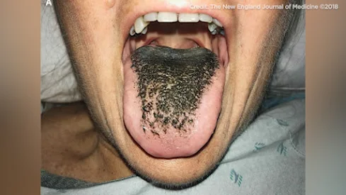 Causes of Black Spot On the Tongue