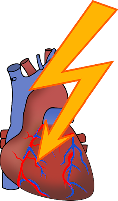 Understanding Heart Attacks: Symptoms, Causes, and Treatment Options
