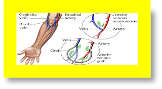 hemodialysis complications hemodialysis meaning hemodialysis machine hemodialysis procedure hemodialysis and peritoneal dialysis