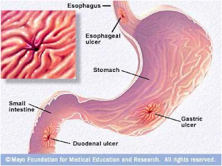 Bacaan Harian Ku: BAHAYA GASTRIK