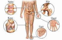 penyakit osteoartritis, Blog Keperawatan