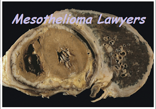 Mesothelioma Lawyers