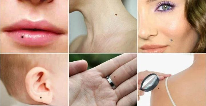 Moles On Different Parts Of Your Body Reveal Your Luck, Your Life And Your Character