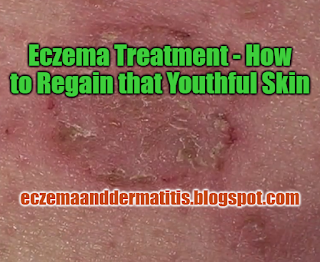 Eczema Treatment - How to Regain that Youthful Skin