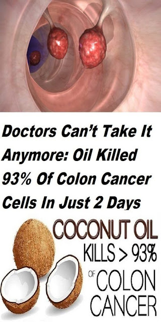 Even The Doctors Are Shocked: Coconut Oil Kills 93% Of Colon Cancer Cells In Only 2 Days