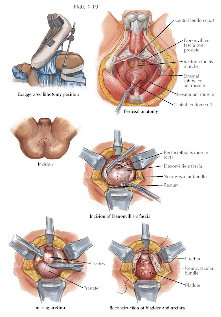 MALIGNANT PROSTATE SURGERY I PERINEAL