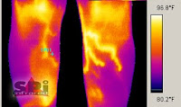 HAMAMELIS Y VARICES