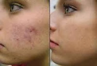 Acne Before,After