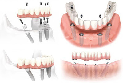 Chi phí trồng răng hàm tại nha khoa hiện nay-2