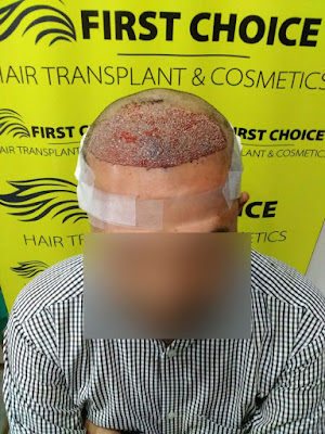 hair transplant result picture