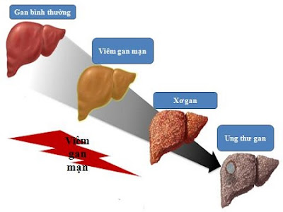 Những biến chứng nguy hiểm từ bệnh xơ gan