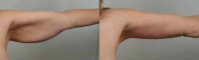 braquioplastia cirugia plastica de brazos en Guadalajara Mexico fotos antes y despues