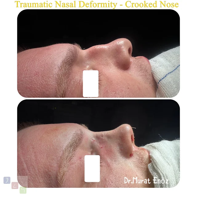 traumatic nasal deformity, crooked nose, rhinoplasty, nasal trauma, nose surgery, facial aesthetics, breathing issues, nasal reconstruction, septoplasty, deviated septum, nose injury, nasal correction, functional rhinoplasty, cosmetic rhinoplasty, nasal fracture, surgical nose repair