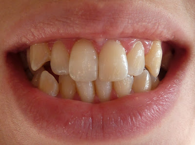 A photo of my teeth before I had orthodontic treatment