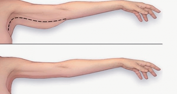 Tak Merasa Nyaman Dengan Lengan Besarmu, Begini Cara Cepat Mengecilkannya! Selamat Mencoba ...