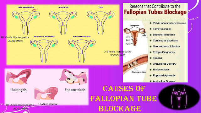 Fallopian Tubal Blockage homeopathy treatment