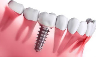 Cấy implant có nguy hiểm không-3