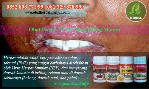 cara menyembuhkan sakit herpes