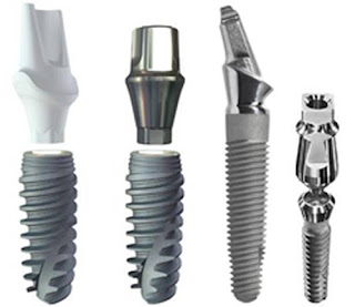 Dental implants Chicago