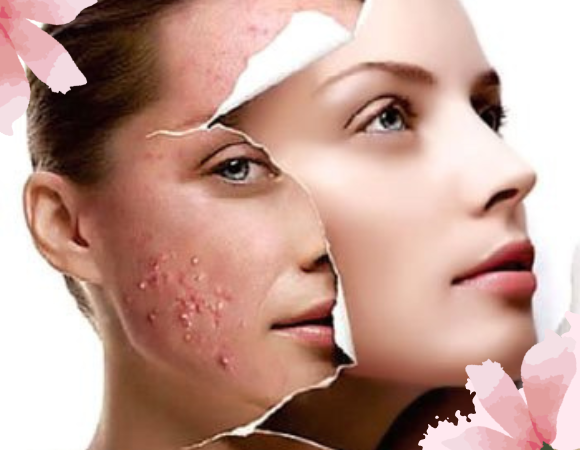 Moringa Benefits for Skin