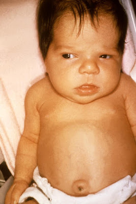 NEONATAL JAUNDICE 