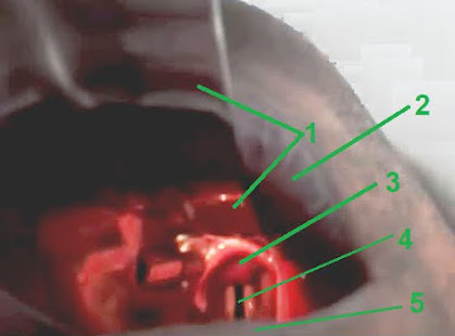 direct laryngoscopy for endotracheal intubation. Emergency medicine free book online