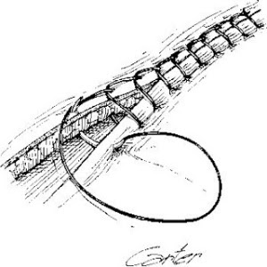 Running locked suture.