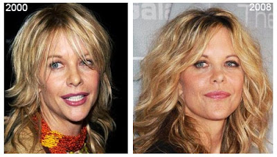 Meg Ryan Plastic Surgery