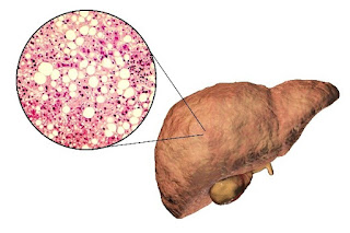 nafld