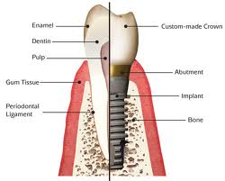 Dental implants Chicago