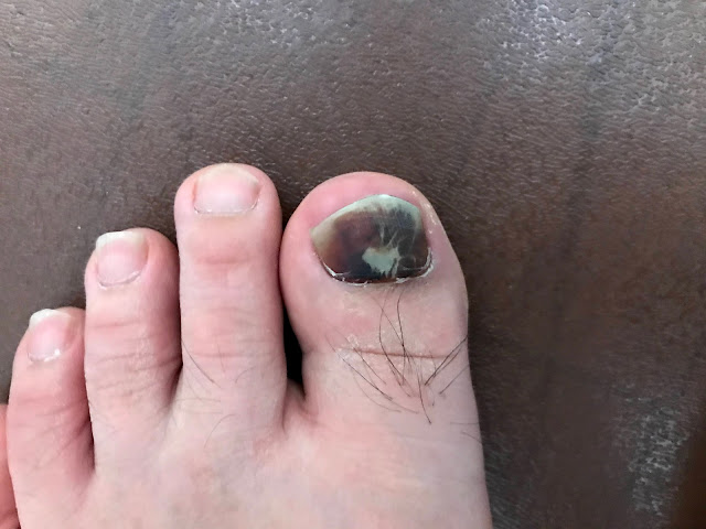 爪下血腫で爪が取れる まさねこ日記