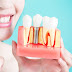 Dental Implants a simple solution for that perfect smile