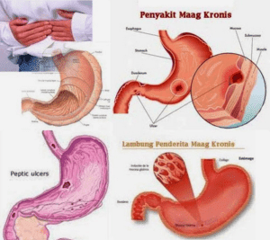 Cara mudah mengatasi asam lambung yang tepat dengan herbal