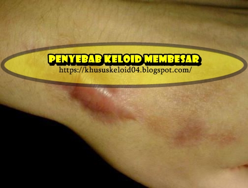 Penyebab Keloid Membesar