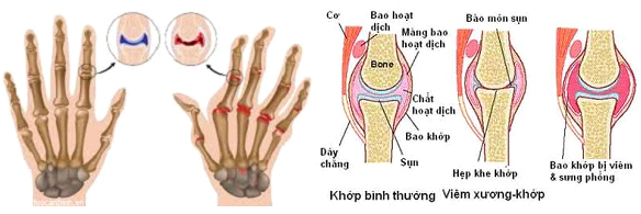 benh-viem-khop