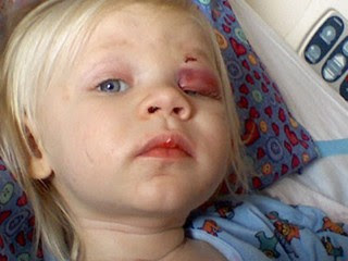 Minn. Child Sticks Screwdriver Into Head, Survives