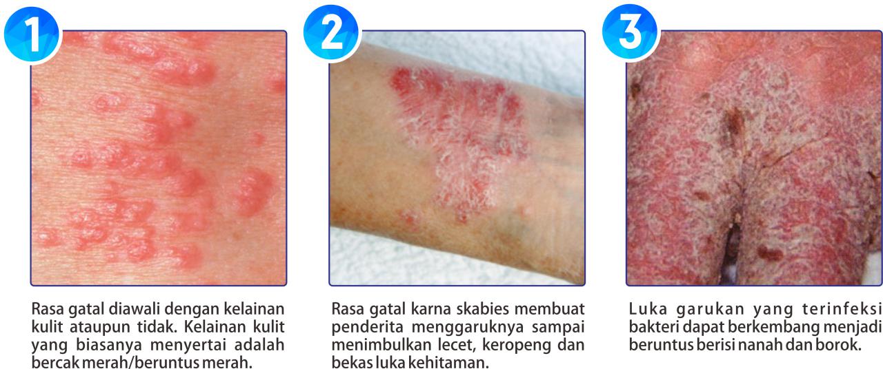 BAGAIMANA CARA MENYEMBUHKAN SCABIES ?  khairulleon.com 