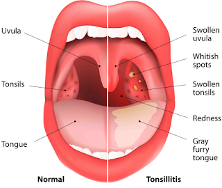 How to Remove and Prevent Tonsil Stones Naturaly at Home