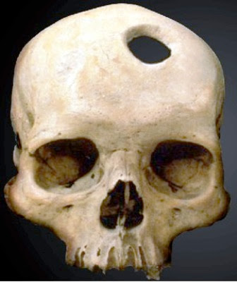 Los cirujanos Incas y las cirugías de cráneo trepanaciones
